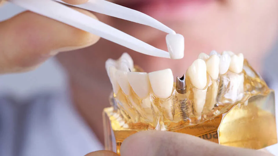 Diş modeli üzerinde implant ve kuronun gösterimi — temsili görsel